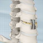 Anterior Cervical Discectomy  with Fusion 
